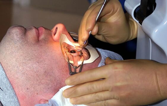 Scleroplasty alang sa myopia aron ma-stabilize ang panan-aw