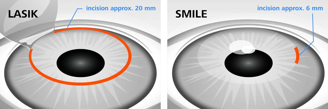 Pagtandi sa mga pamaagi sa pagtul-id sa panan-awon sa laser LASIK ug SMILE